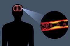 Ketahui Gejala Stroke Ringan, yang Sering Dikira Migrain