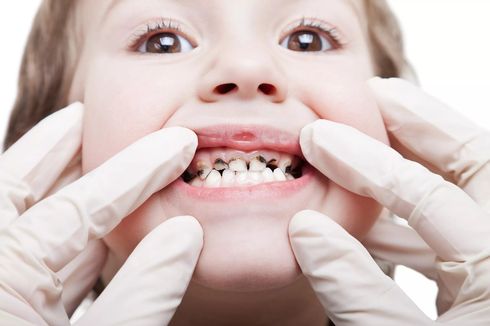 13 Cara Mencegah Gigi Anak Berlubang