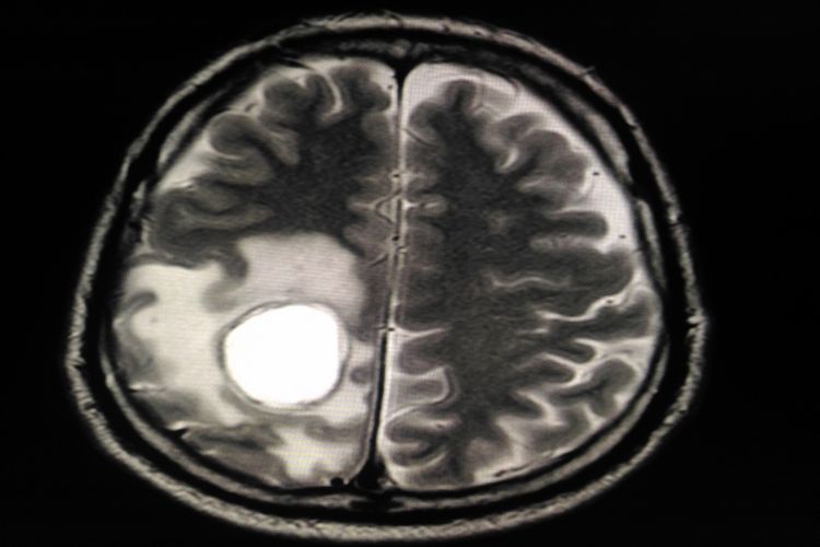 Ilustrasi hasil MRI abses otak