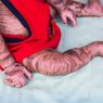 Ichthyosis Harlequin