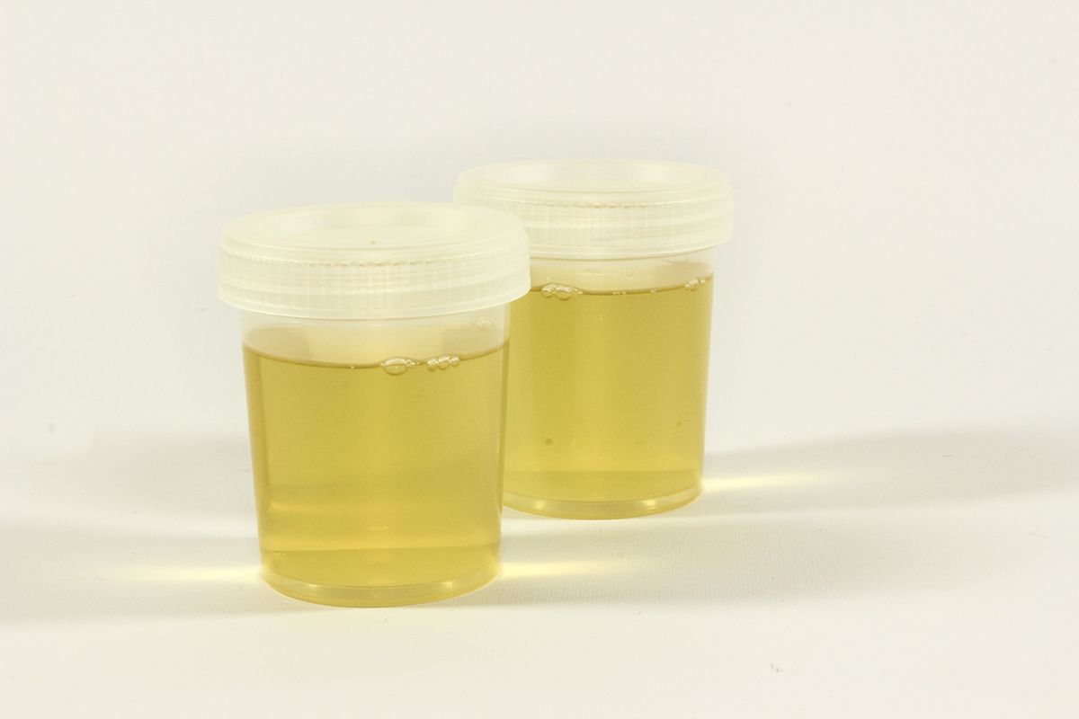 Ilustrasi urine yang sehat