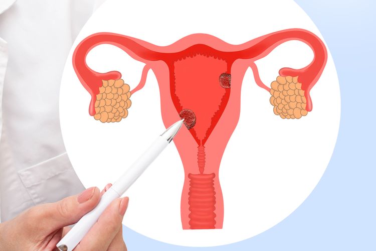 Ilustrasi polip rahim, gejala polip rahim, penyebab polip rahim, apakah polip rahim bisa sembuh sendiri, perbedaan polip dan miom di rahim. 