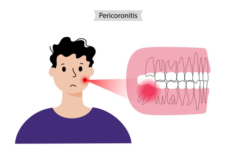 Ilustrasi  Perikorintis