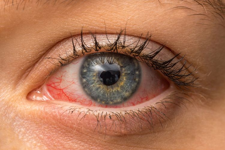 Salah satu penyebab mata merah sebelah kiri adalah alergi yang umumnya dibarengi dengan gejala lainnya.