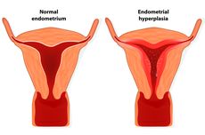Penyebab Penebalan Dinding Rahim yang Normal dan Tidak Normal