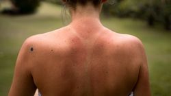 Peneliti Ungkap Rahasia di Balik Kulit Gosong Sunburn, Bukan DNA
