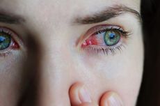 Alami Mata Merah dan Berair? Waspada Gejala Dry Eye