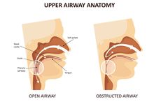 Obstruksi Saluran Napas Atas