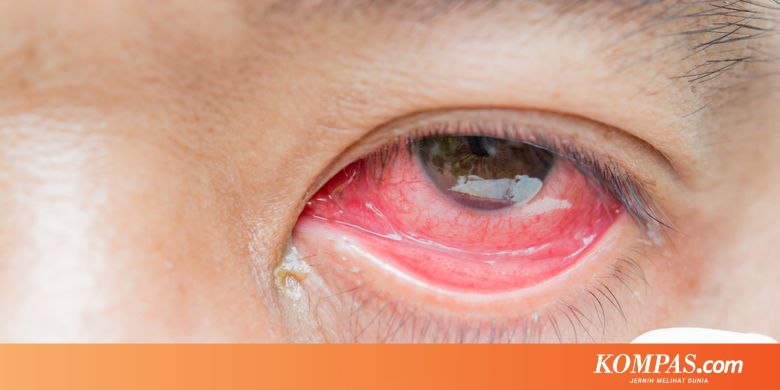 Mengenal Konjungtivitis, dari Penyebab hingga Penanganannya...