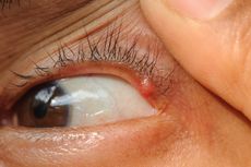 10 Penyebab Mata Terasa Mengganjal dan Berair