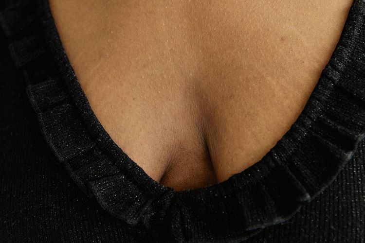Stretch mark pun bisa muncul di payudara dan menjadi masalah tersendiri bagi para perempuan.