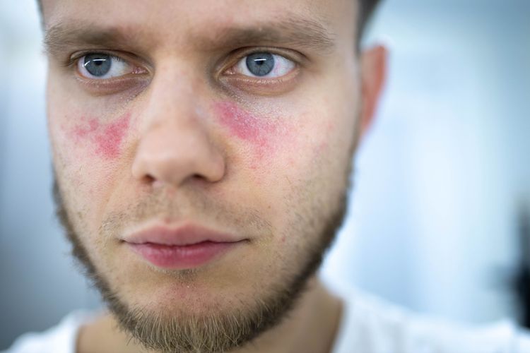 Ilustrasi penyakit lupus yang muncul di kulit wajah. Apa itu penyakit lupus? Ini adalah penyakit autoimun yang akan berlangsung seumur hidup. 
