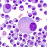 Multiple Myeloma, Gejala dan Perawatannya