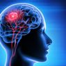 Penyebab Glioblastoma, Tumor Otak Ganas yang Harus Diwaspadai