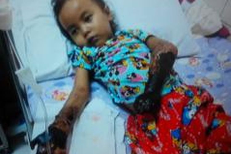 Puvelia Audriana Putri (5) diduga menjadi korban malapraktik. Kedua tangannya hangus akibat infeksi bekas infusan.