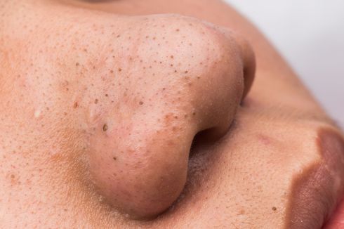 5 Skincare Penghilang Komedo, dari Asam Salisilat sampai Retinol
