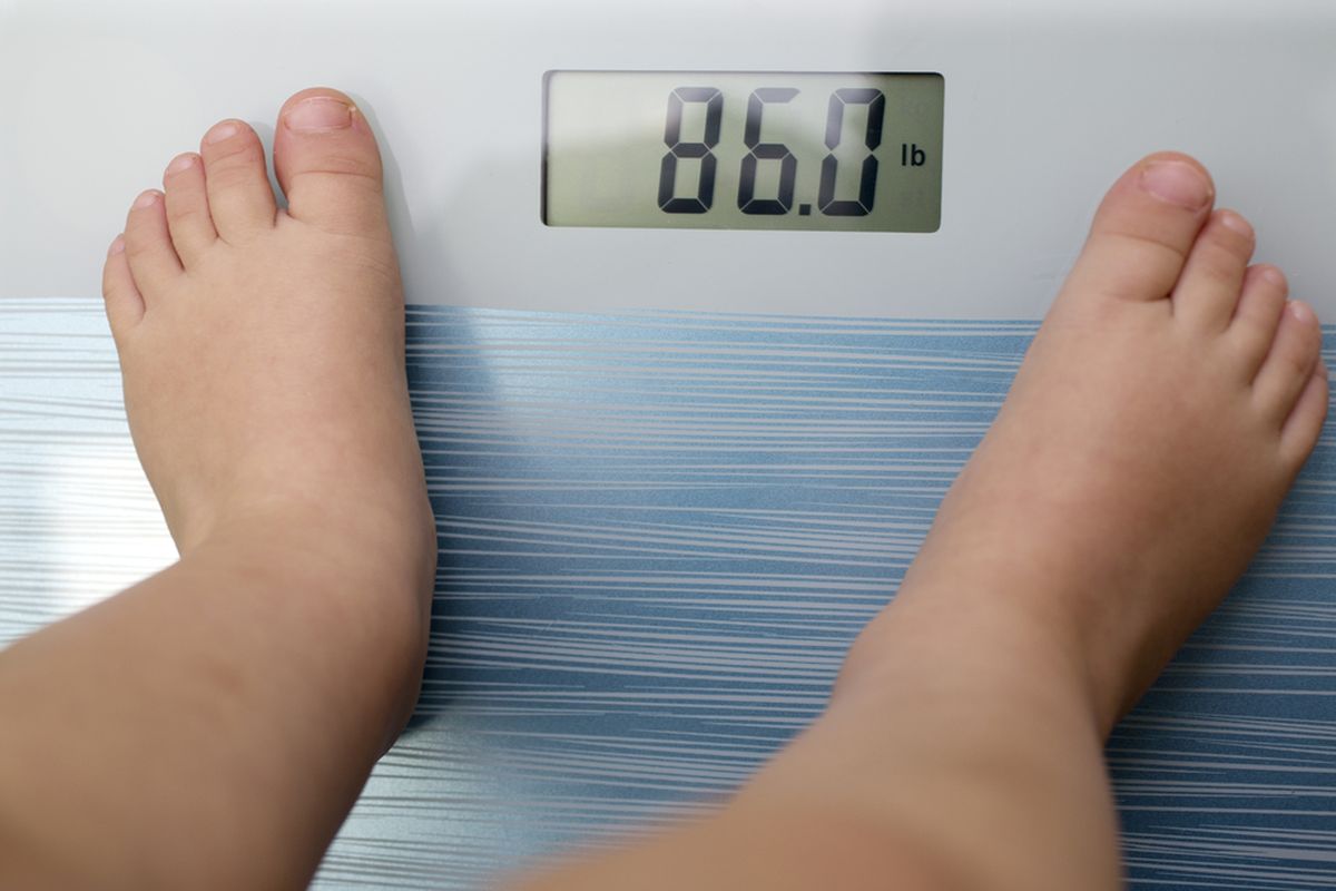 Ilustrasi anak obesitas akibat gizi berlebih.