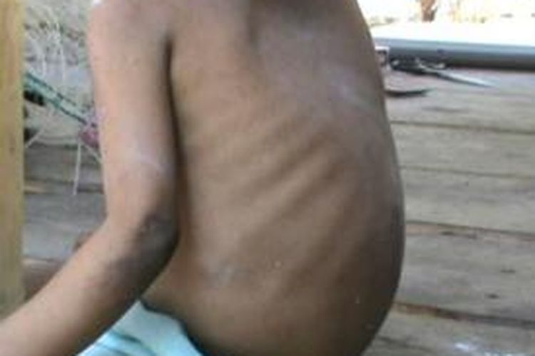 Satria bocah tiga tahun asal Desa Galeso kecamatan Wonomulyo Polewlai Mandar sulawesi barat berat badannya hanya 7 kilogram. Asupan gisi yang tidak berimbang mmebuat pertumbuhan bocah ini diduga tidak normnal hingga satria mengalami gizi buruk.