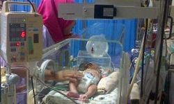 Rahang Bermasalah,  Bayi Kembar Parasit Makan Lewat Selang 