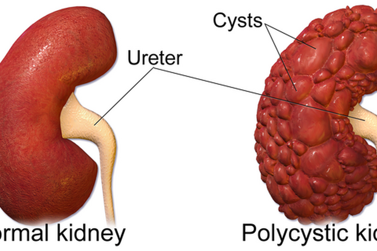 Ilustrasi ginjal yang mengalami penyakit ginjal polikistik. Penyakit ginjal polikistik adalah salah satu kelainan bawaan yang umum sebagai penyebab gagal ginjal pada anak hingga membutuhkan cuci darah. 