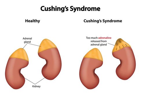 Sindrom Cushing