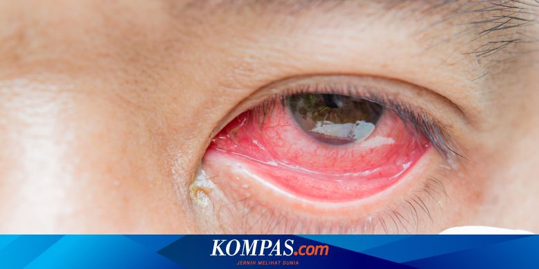 Viral Foto Mata Merah Karena Pembuluh Pecah Akibat Main Ponsel Ini Penjelasan Dokter Halaman All Kompas Com