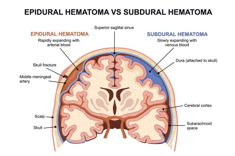 Ilustrasi epidural hematoma vs subdural hematoma