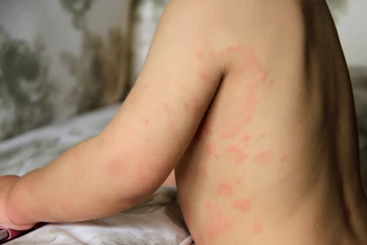 Alergi pada anak bisa berupa bentol-bentol di seluruh tubuh. 