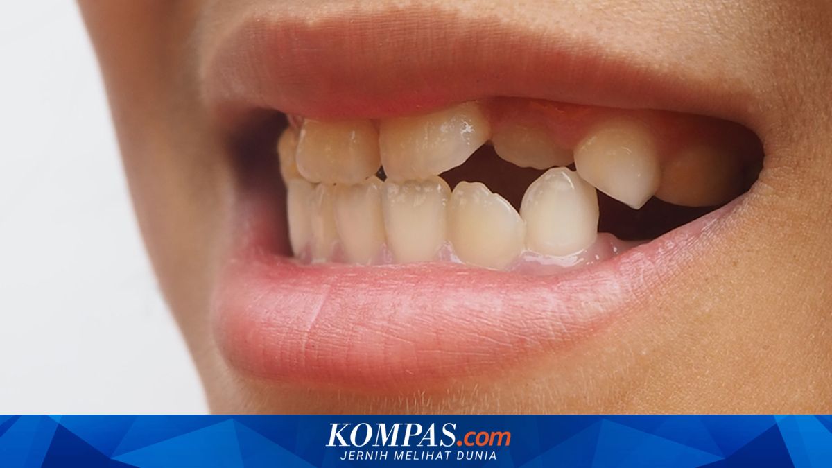 Apakah Gigi Tidak Rapi Bisa Diperbaiki?