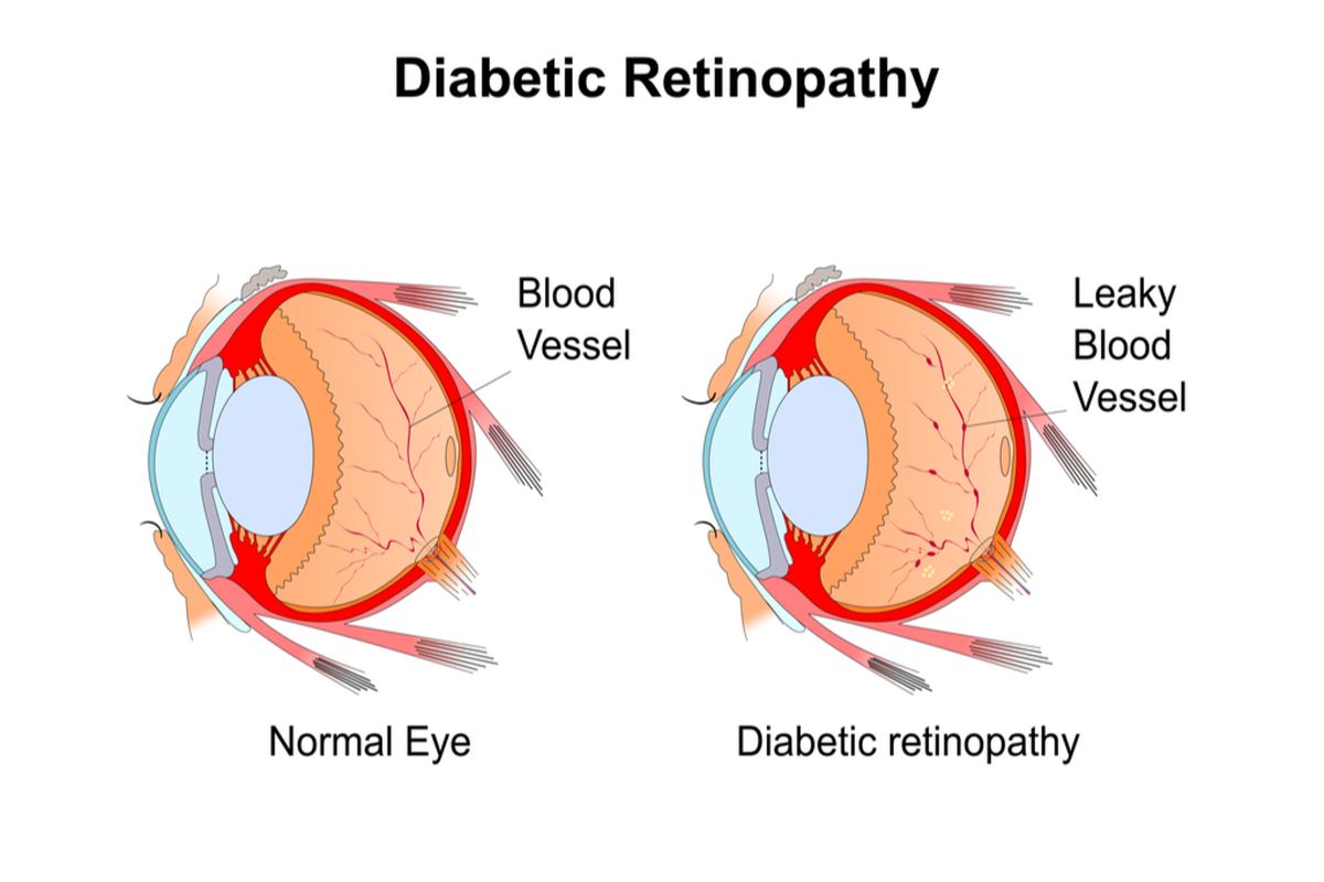 ilustrasi retinopati diabetik