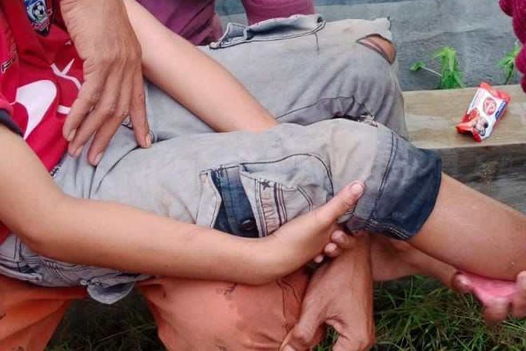 Febriawan (11), salah seorang korban gigitan anjing rabies di Kabupaten Dompu, Rabu (16/11/2022).