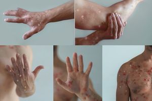 WHO Peringatkan Penularan Mpox Bisa Lewat Droplet