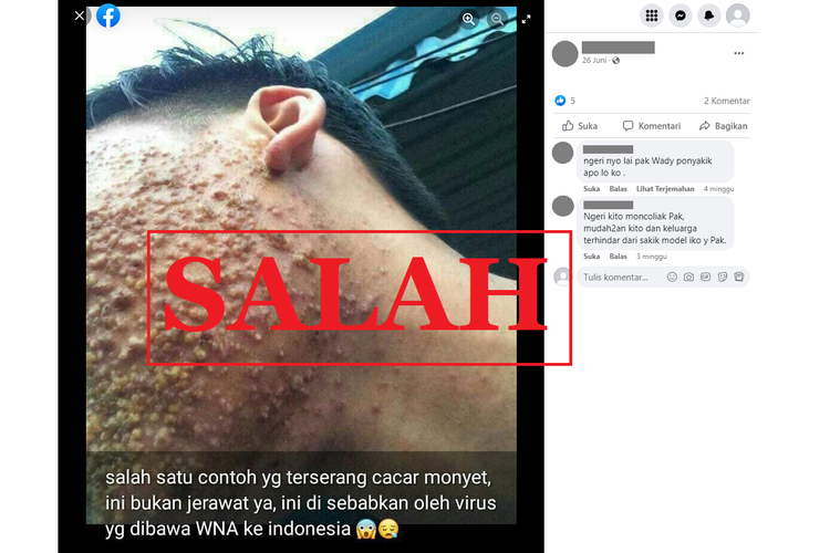 Tangkapan layar unggahan dengan narasi menyesatkan di sebuah akun Facebook, 26 Juni 2022, menampilkan foto wajah seseorang terkena cacar monyet yang dibawa WNA ke Indonesia.