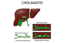 Cholangitis 