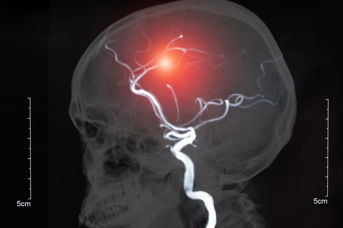 Aneurisma otak bisa terjadi karena dinding arteri di organ vital ini menipis dan melemah. Pemicunya bisa tekanan darah tinggi (hipertensi).