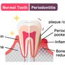 Periodontitis 