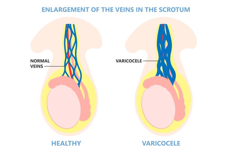 Ilustrasi Varikokel