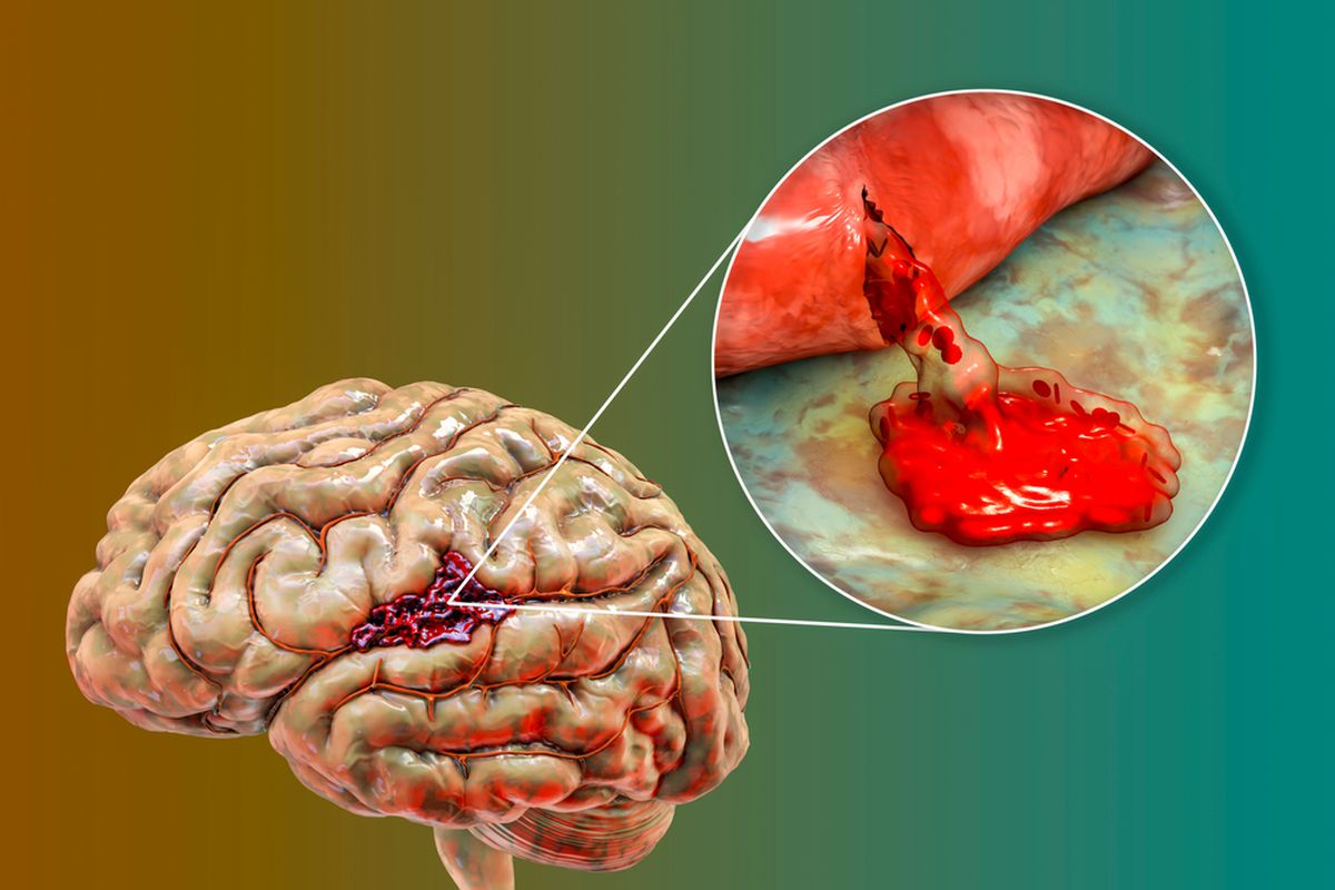 16 Ciri-ciri Pendarahan Otak yang Pantang Diabaikan