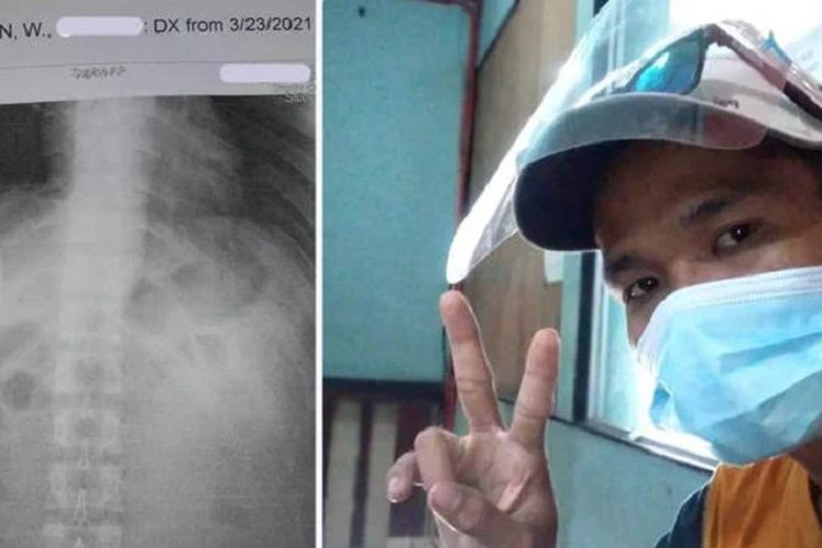 Kent Ryan Tomao (kanan), seorang pemuda di Filipina yang begitu terkejut saat mendapati ada pisau yang menancap di paru-parunya.