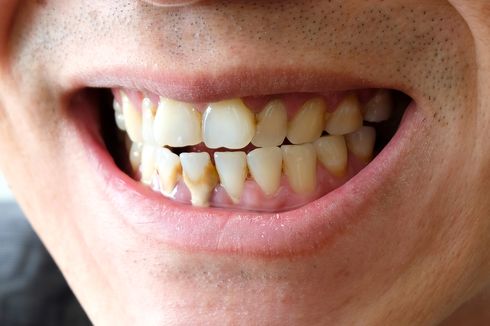7 Cara Mencegah Karang Gigi yang Baik Dilakukan 