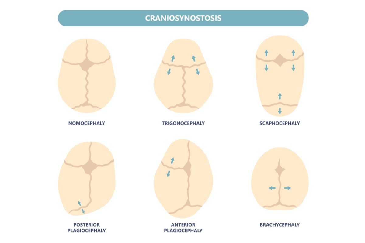 Ilustrasi craniosynostosis