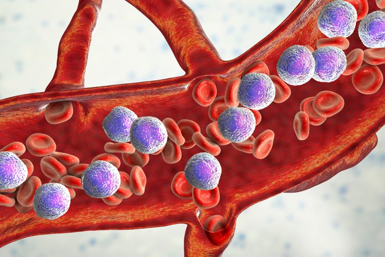 Kanker darah secara umum terjadi karena adanya mutasi DNA di sel darah. Namun, mungkin ada kombinasi dari faktor lainnya, seperti merokok dan riwayat kemoterapi.