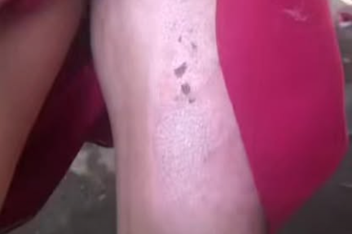 Tangkapan layar kaki anak di Jember yang melepuh karena disiram menggunakan air panas