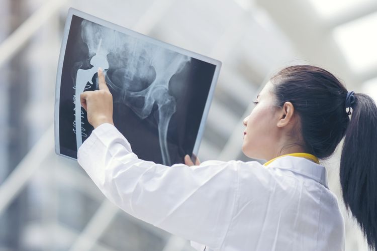 Seorang dokter sedang memeriksa hasil X-Ray pasien kanker tulang. Cara mencegah kanker tulang adalah dengan melakukan deteksi dini. 