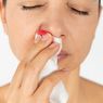 10 Penyebab Mimisan yang Sering Disepelekan