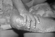 Anak dengan Sistem Imun Lemah Rentan Terkena Monkeypox