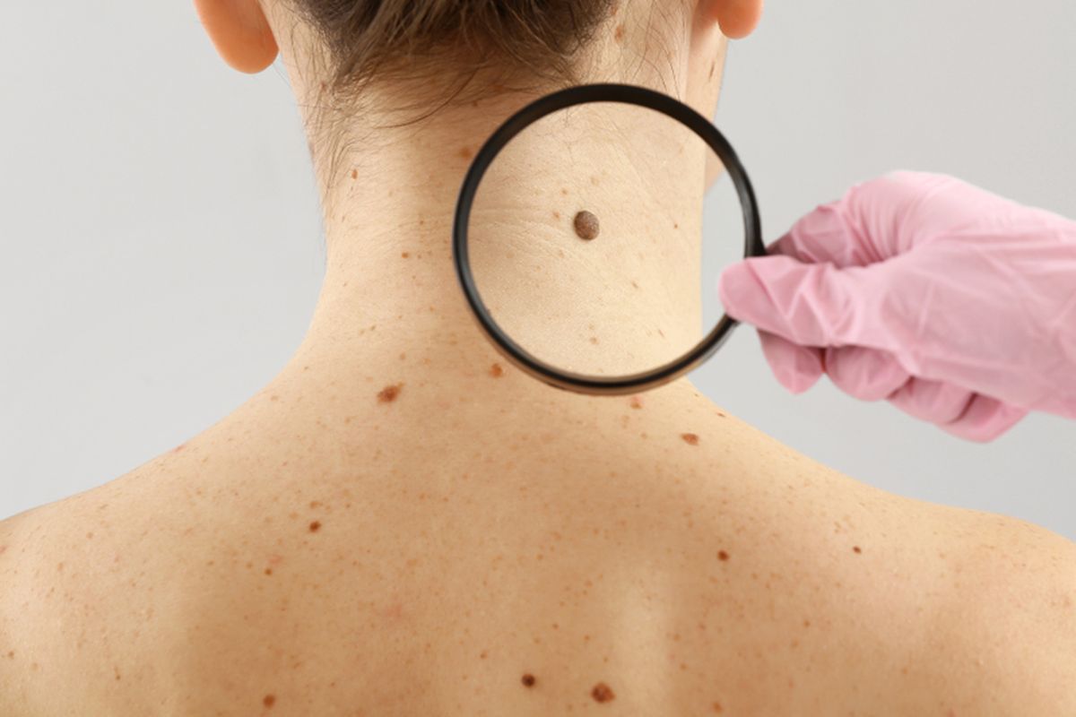 Ilustrasi kanker kulit melanoma. Ada banyak jenis kanker kulit, yang umum adalah karsinoma sel basal, karsinoma sel skuamosa, dan melanoma.