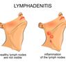 Limfadenitis