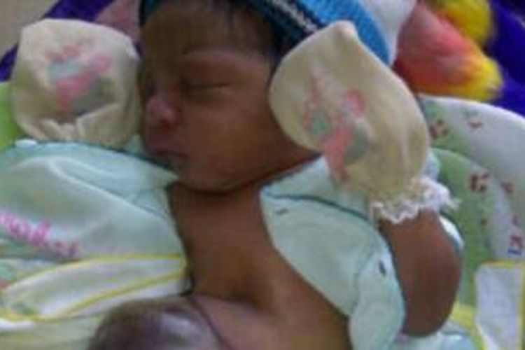 Yusuf Tewernussa, bayi yang baru berusia dua hari lahir tanpa dinding perut, dan saat ini tengah menjalani perawatan medis di RUSD Masohi, Rabu (17/9/2014)