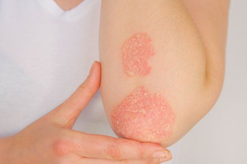 Psoriasis, Penyakit Autoimun yang Bikin Kulit Meradang dan Bersisik